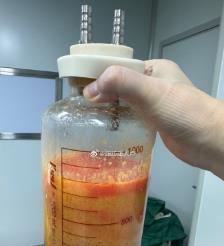 咸阳水动力吸脂手术要做多久？